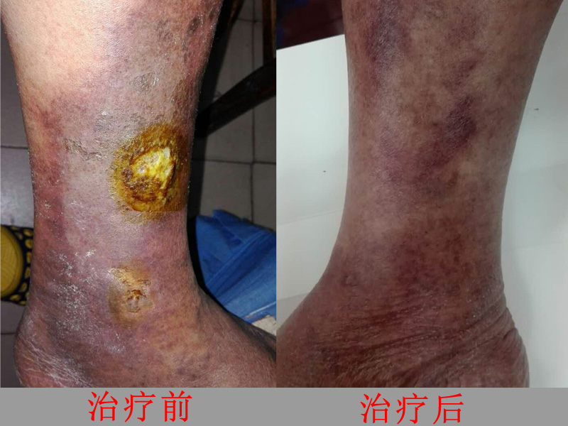 治疗前后对比