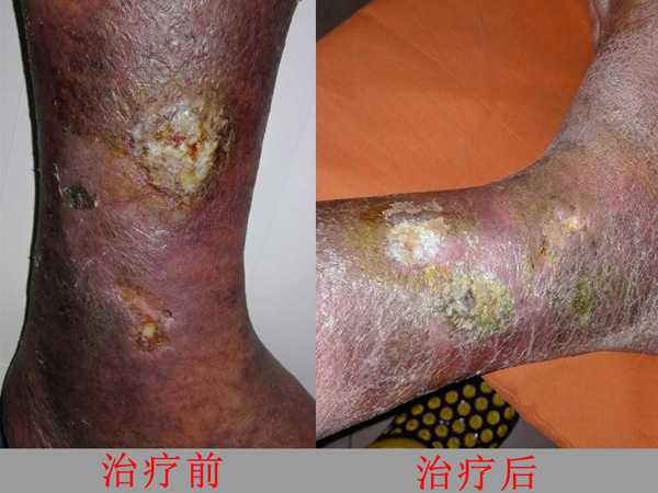 治疗前后对比