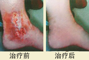 老烂腿的症状诊断及治疗